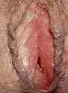 genital-herpes-female